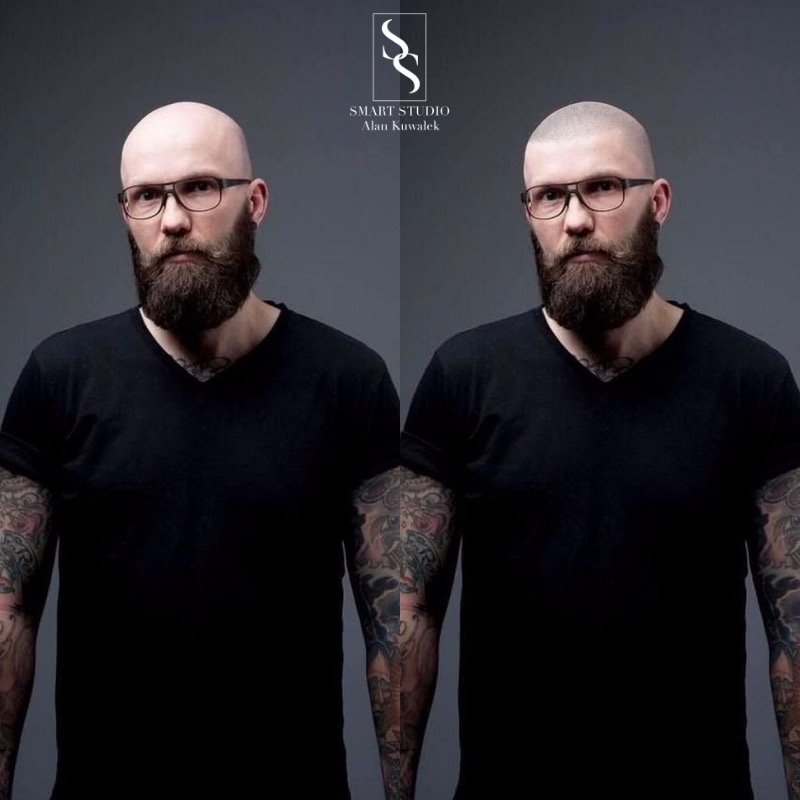 MIKROPIGMENTACJA SKÓRY GŁOWY 🔥🔥🔥Wizualizacja online🔥🔥🔥