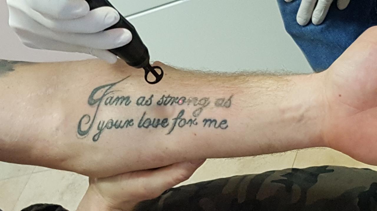 Usuwanie tatuażu na przedramieniu za pomocą lasera, widoczne białe rękawiczki ochronne i fragment kamuflażowych spodni.