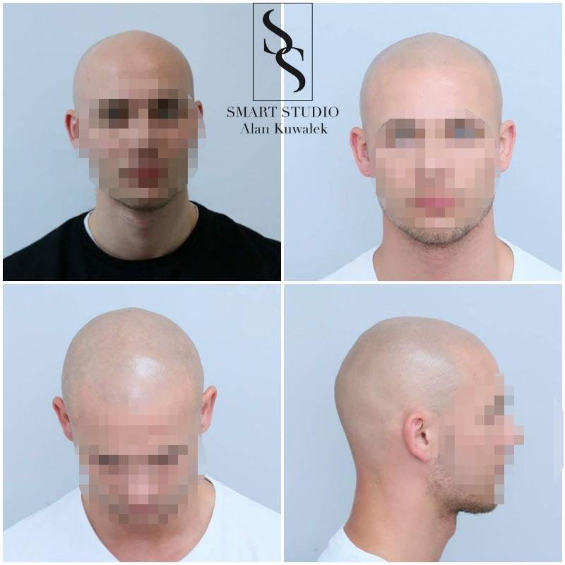 Cztery ujęcia głowy mężczyzny przed i po zabiegu mikropigmentacji skóry głowy, z widocznym logo Smart Studio w górnym lewym rogu.