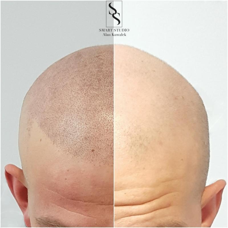 Głowa mężczyzny przed i po zabiegu mikropigmentacji skóry głowy, widoczne efekty zagęszczenia włosów, logo studia w górnej części kadru.