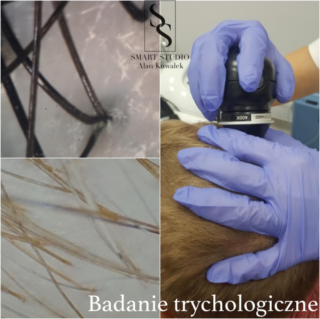 Trycholog bada skórę głowy pacjenta za pomocą dermatoskopu, widoczne powiększenia struktury włosów i skóry głowy w lewym górnym i dolnym rogu, logo studia w tle.