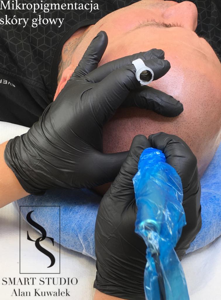 Mikropigmentacja skóry głowy w trakcie zabiegu: widoczne dłonie w czarnych rękawiczkach, urządzenie do pigmentacji z niebieskim zabezpieczeniem oraz skóra głowy klienta.