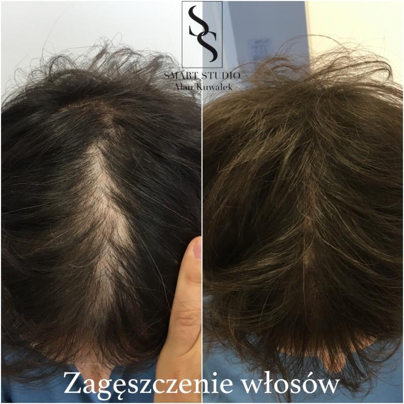 Zdjęcie porównawcze przed i po zabiegu zagęszczania włosów, widoczny efekt wizualny na ciemnych włosach z wyraźnym prześwitem na głowie przed zabiegiem i gęstsze włosy po zabiegu.