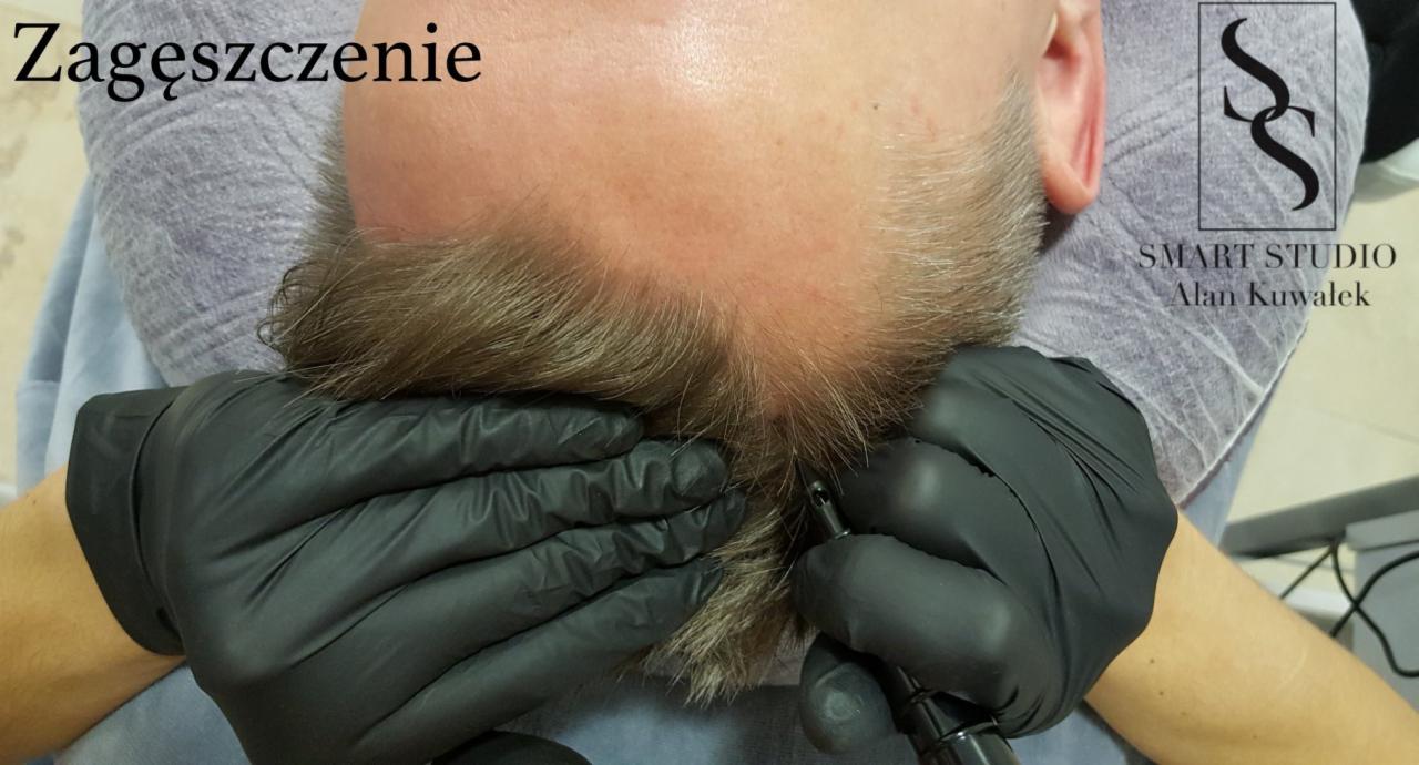 Mikropigmentacja skóry głowy: zagęszczanie włosów u mężczyzny, widoczne dłonie w czarnych rękawiczkach aplikujące pigment, logo studia w tle.