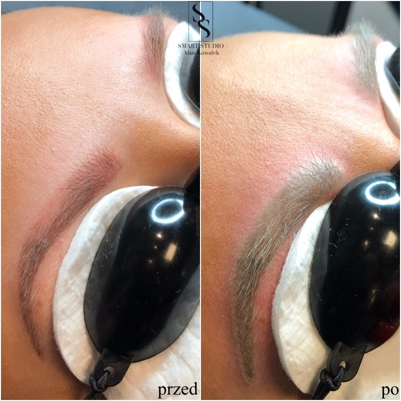 Porównanie brwi przed i po zabiegu laserowego usuwania makijażu permanentnego; lewa strona przedstawia brwi przed zabiegiem, prawa po, widoczne zaczerwienienie skóry.