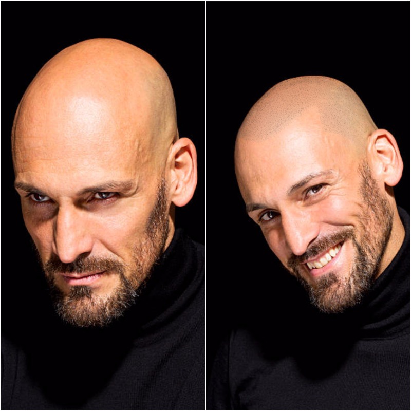 Mężczyzna przed i po mikropigmentacji skóry głowy: po lewej surowy wyraz twarzy, po prawej uśmiech z widocznym efektem pigmentacji, czarne tło, zbliżenie na twarz.