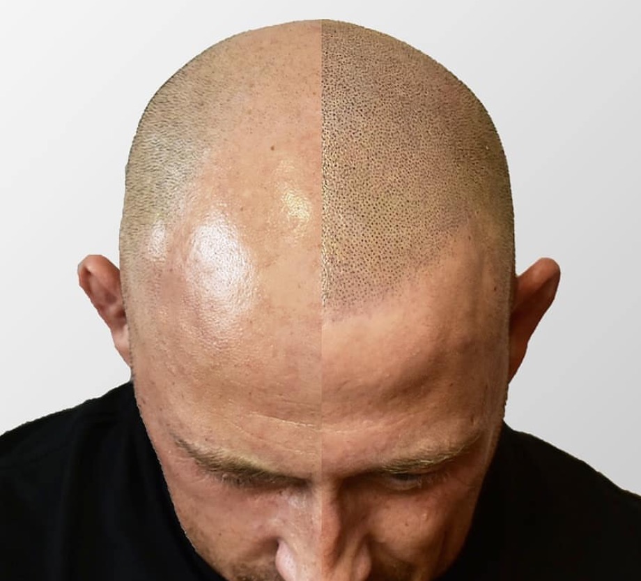 Mikropigmentacja Skóry Głowy