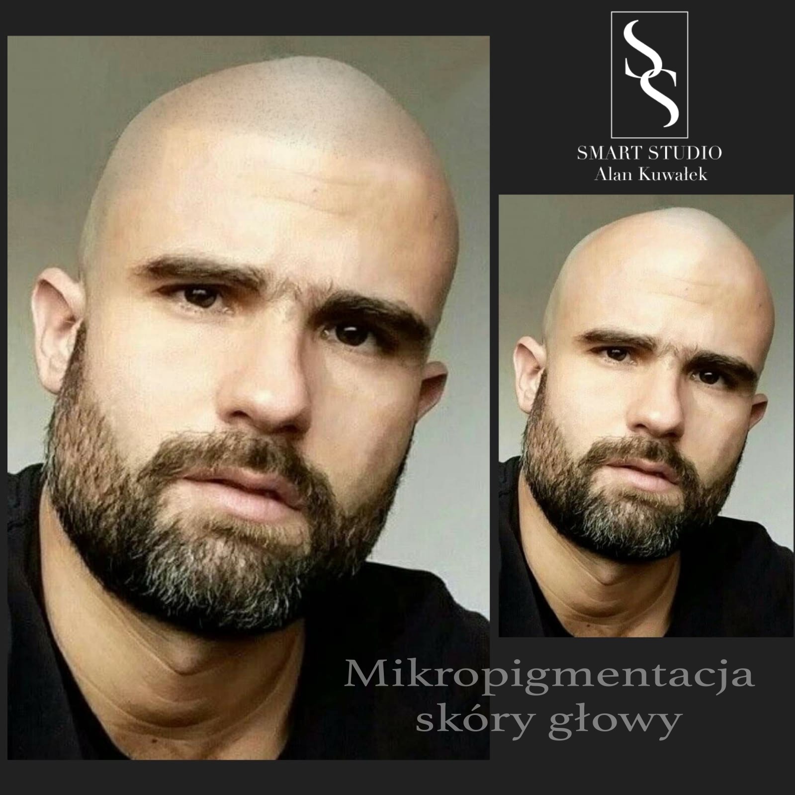 Mężczyzna z mikropigmentacją skóry głowy, widoczny z bliska na dwóch ujęciach obok siebie; w prawym górnym rogu logo studia.