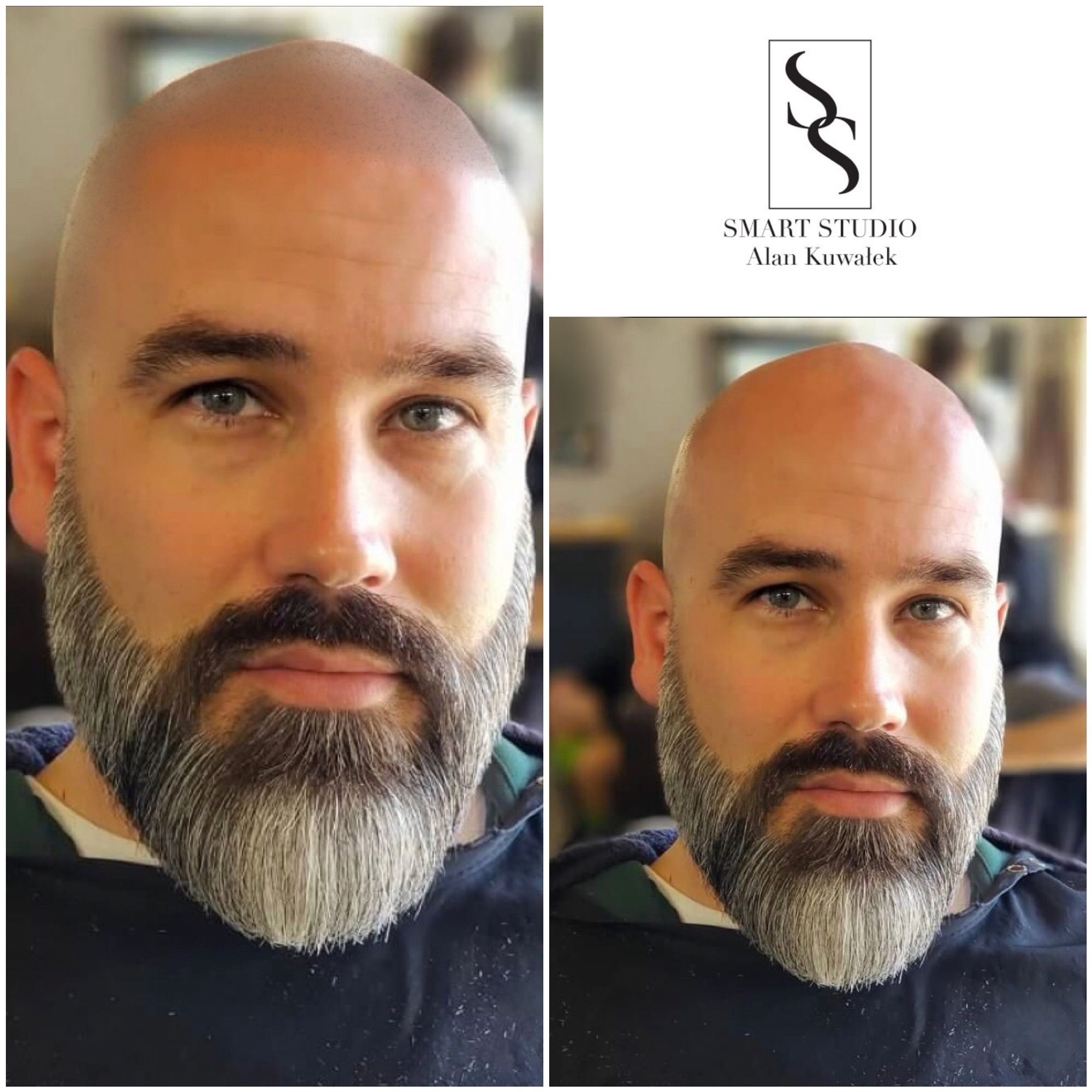 MIKROPIGMENTACJA SKÓRY GŁOWY ✅ Wizualizacja online