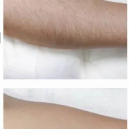 Porównanie efektu fotoepilacji: przed i po serii zabiegów, widoczne zmniejszenie owłosienia na ramieniu.