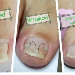 Kolekcja trzech zbliżeń dużego palca u nogi: przed kuracją z widoczną deformacją paznokcia, w trakcie korekcji z założonymi metalowymi klamrami, i po zakończonej kuracji z widocznie poprawionym...