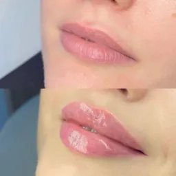 Porównanie ust przed i po zabiegu powiększania, delikatny różowy odcień, widoczny efekt nawilżenia i wypełnienia.