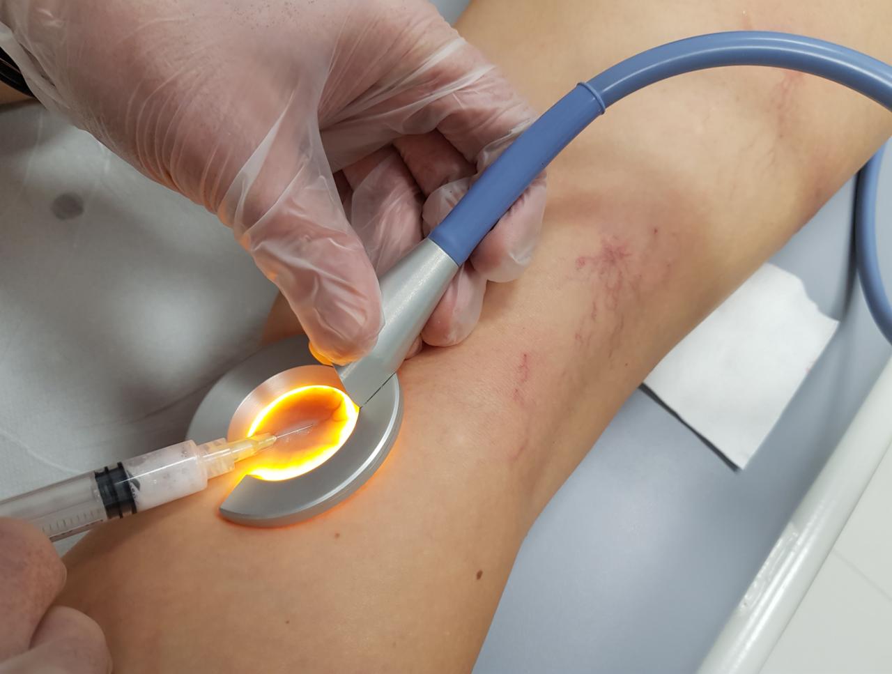 Zabieg likwidacji pajączków na nodze pacjenta z użyciem lasera i igły, widoczne drobne naczynia krwionośne.