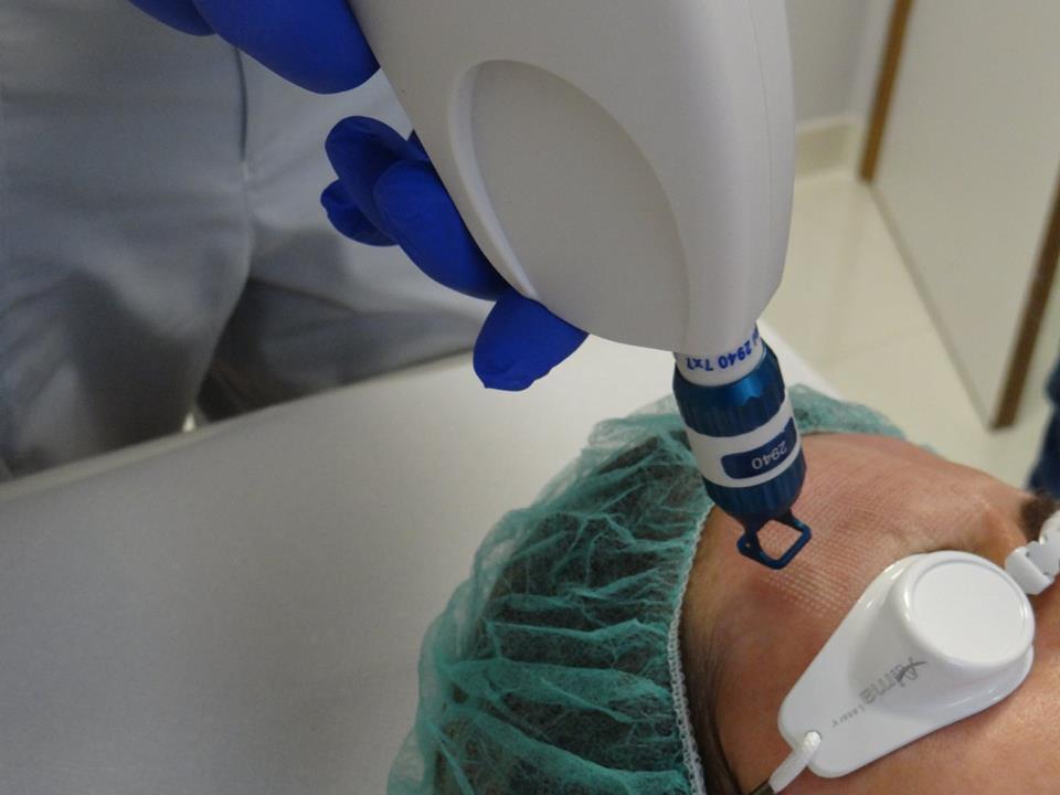 Zabieg laserowy na twarzy pacjenta w zielonym czepku ochronnym, wykonywany przez osobę w niebieskich rękawiczkach, widoczny aplikator lasera z oznaczeniem 2940 TXT.