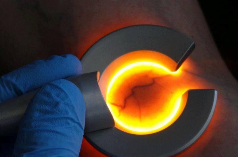 Podświetlenie żył na skórze pacjenta za pomocą specjalistycznego urządzenia z niebieską rękawiczką ochronną.