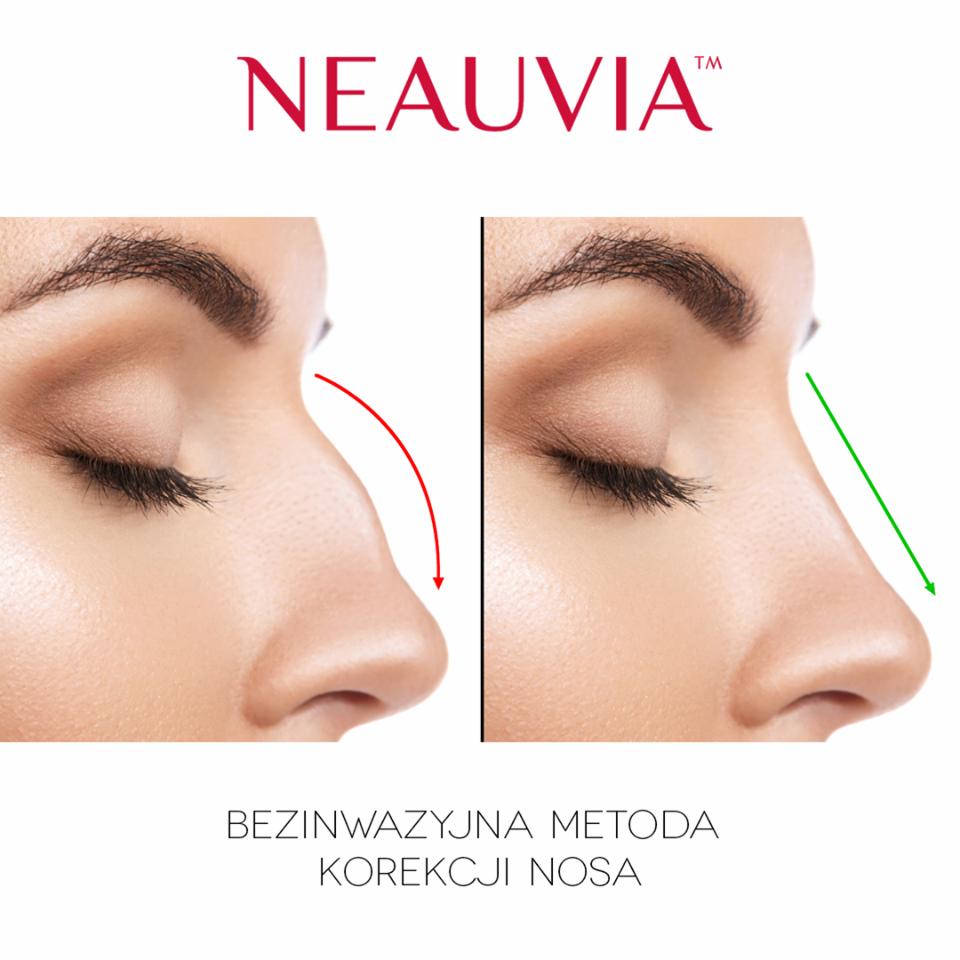 Porównanie profilu nosa przed i po zabiegu bezinwazyjnej korekcji, zaznaczone czerwoną krzywą i zieloną linią, logo NEAUVIA u góry.