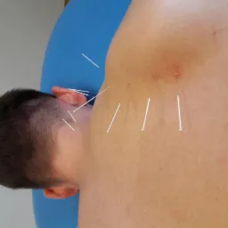 Pacjent leżący na boku z igłami do akupunktury w górnej części pleców i szyi, widoczne zaczerwienienie skóry w miejscu wkłucia.