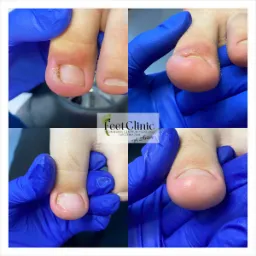 Kolaż przedstawiający palce stóp przed i po zabiegu, z naciskiem na poprawę wyglądu paznokci, trzymane w dłoniach w niebieskich rękawiczkach ochronnych, z widocznym logo Feet Clinic.