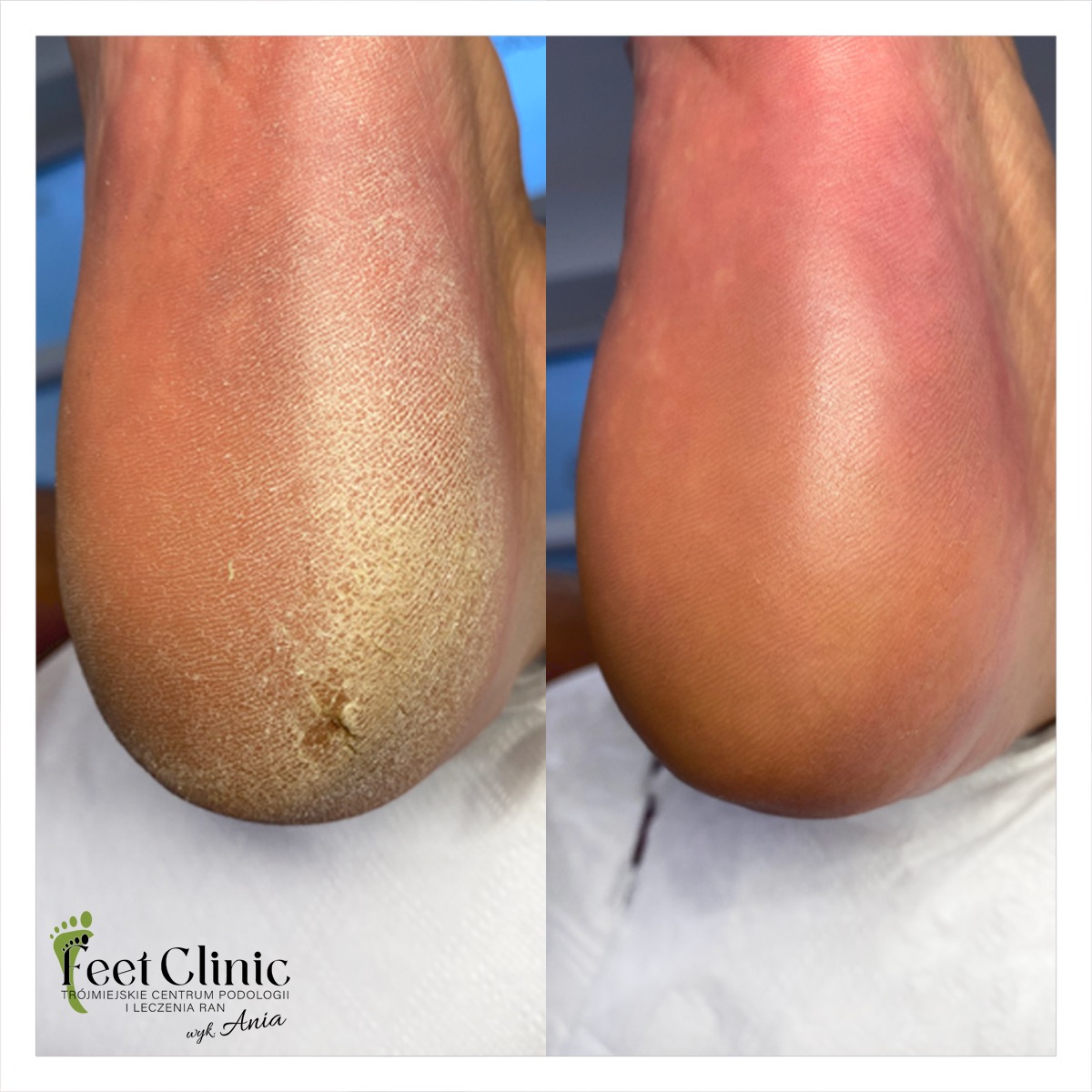 Pięta przed i po zabiegu podologicznym: usunięty zrogowaciały naskórek, widoczna poprawa kondycji skóry.