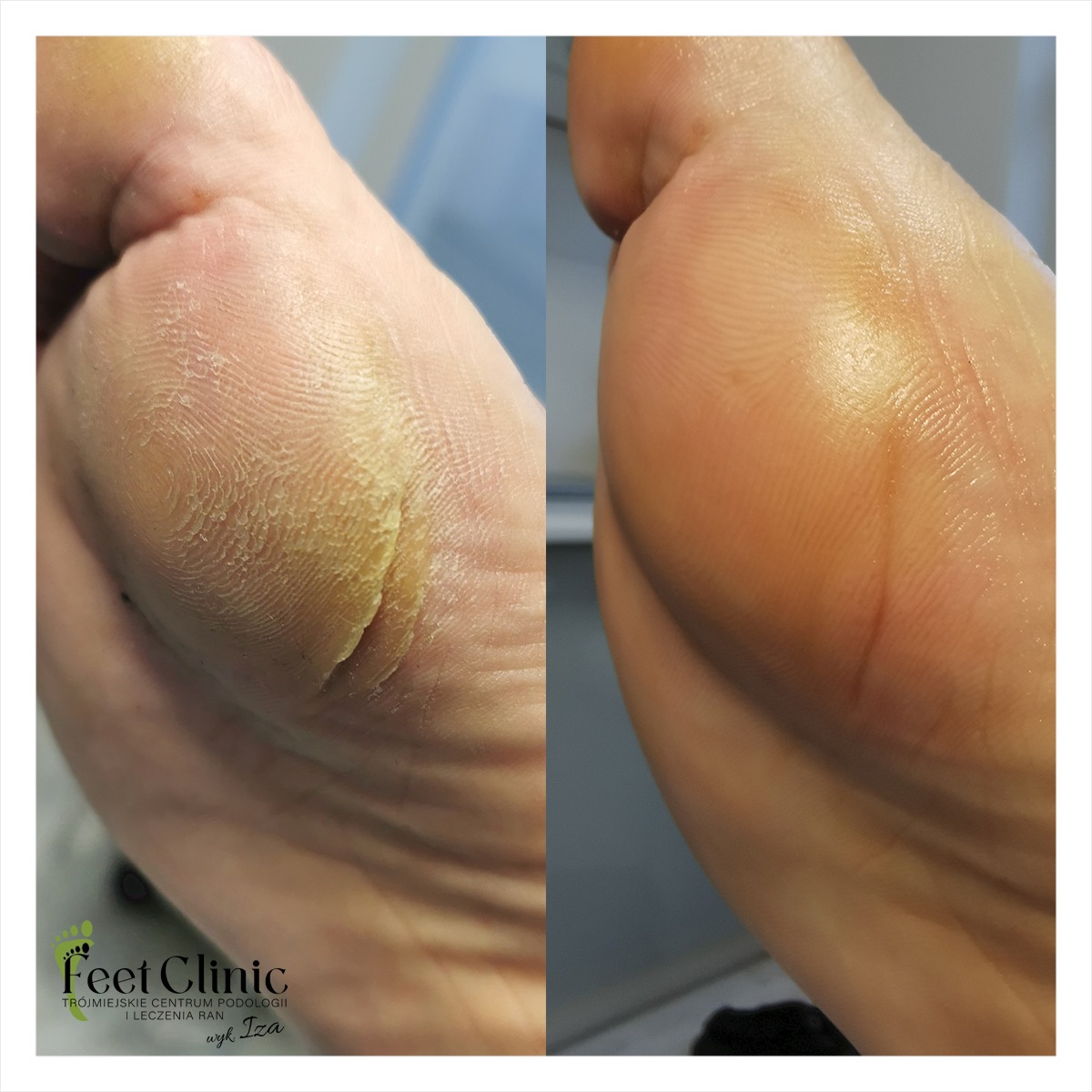 Porównanie stopy przed i po zabiegu pedicure: usunięta zrogowaciała skóra na pięcie, widoczne nawilżenie i gładkość skóry.