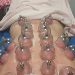 Plecy pacjenta z aplikowanymi bańkami próżniowymi, widoczne zaczerwienienia skóry, na głowie siatka ochronna na włosy, w tle dekoracja ścienna w stylu boho.