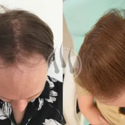 Zdjęcie porównawcze: głowa mężczyzny przed i po zabiegu przeszczepu włosów, widoczne różnice w gęstości i wyglądzie włosów.