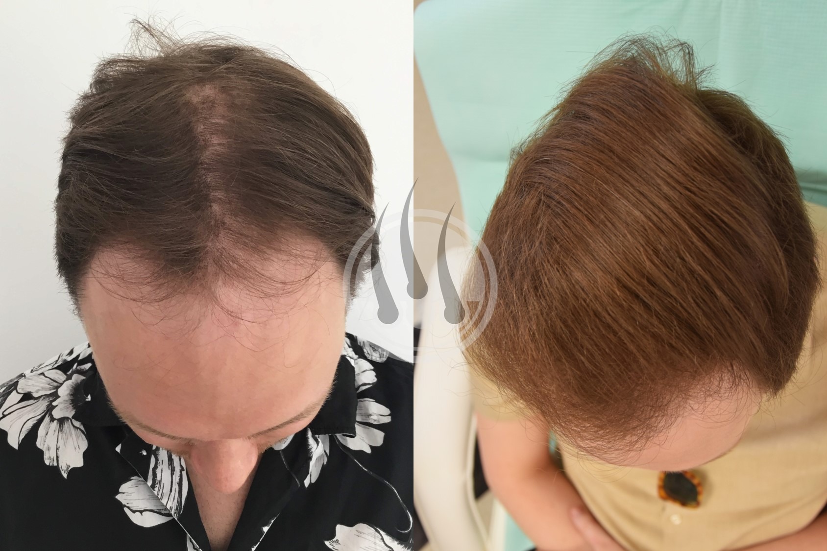 Zdjęcie porównawcze: głowa mężczyzny przed i po zabiegu przeszczepu włosów, widoczne różnice w gęstości i wyglądzie włosów.