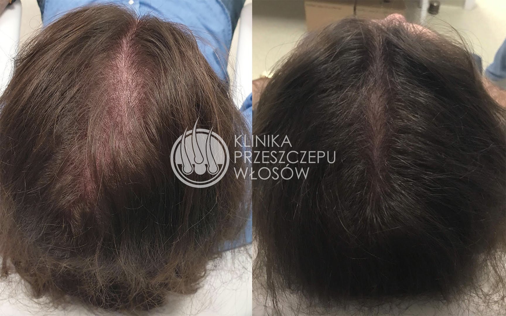 Zdjęcie porównawcze przed i po zabiegu przeszczepu włosów, widok z góry na skórę głowy i włosy pacjenta, po lewej stronie widoczny obszar z przerzedzonymi włosami, po prawej stronie włosy gęstsze...