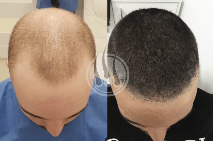 Zdjęcie porównawcze: głowa mężczyzny przed i po zabiegu przeszczepu włosów, widoczne różnice w gęstości i linii włosów.