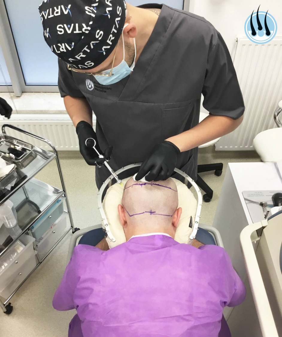 Lekarz w szarym uniformie, masce i czepku wykonuje zabieg na głowie pacjenta z zaznaczonymi liniami, używając strzykawki z cienką igłą, asystując sobie narzędziem w czarnej rękawicy.