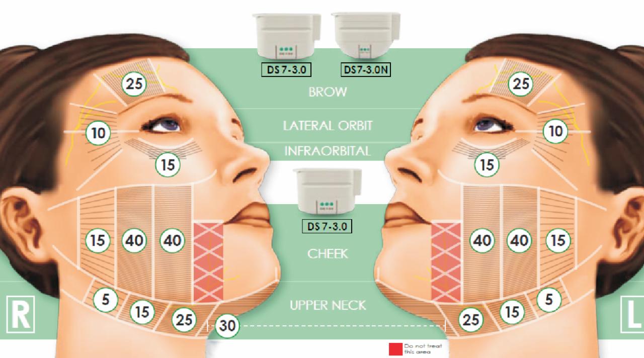 Ilustracja schematyczna twarzy z zaznaczonymi obszarami do zabiegu z użyciem urządzenia DS7-3.0 i DS7-3.0N, wskazane obszary to: brwi, okolice oczodołów, policzki i górna część szyi.