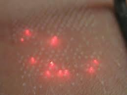 Fragment skóry poddawany zabiegowi laserowemu, widoczne punkty światła lasera na powierzchni skóry.