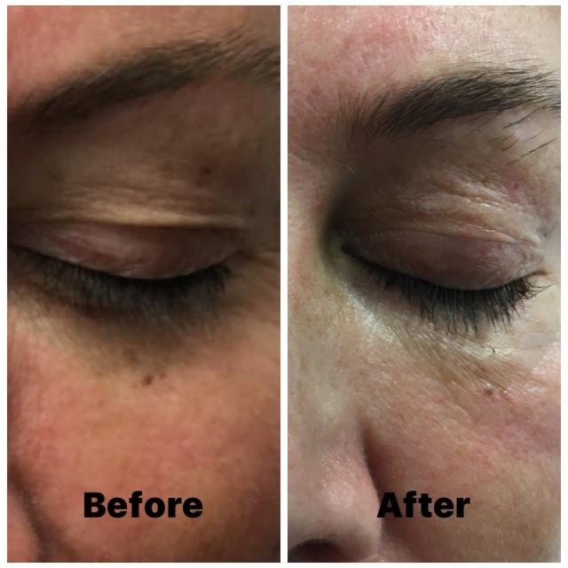 Zdjęcie przedstawia porównanie skóry pod okiem przed i po zabiegu. Po lewej stronie widoczna skóra z zmarszczkami i przebarwieniami, po prawej skóra wyraźnie gładsza i jaśniejsza.