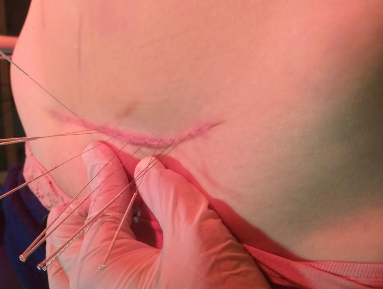 Blizna na ciele pacjenta z wbitymi igłami do akupunktury, wykonywana przez osobę w rękawiczkach ochronnych.