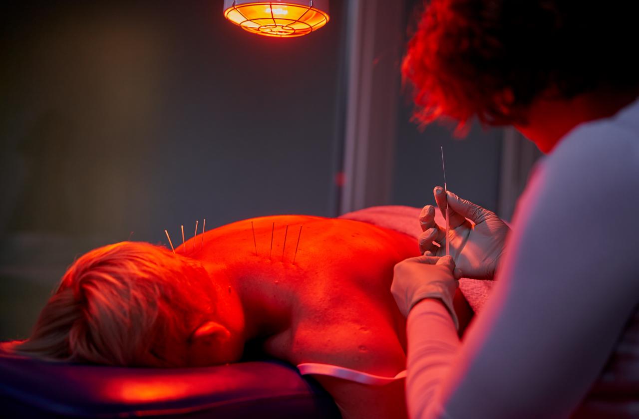 Pacjentka leżąca na brzuchu pod czerwoną lampą, z igłami do akupunktury wbitymi w plecy; terapeuta w rękawiczkach trzyma kolejną igłę.