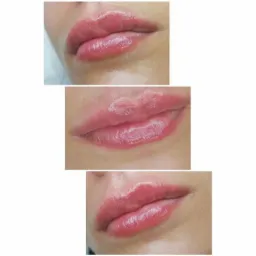 Potrójne zbliżenie na usta po zabiegu, ukazujące efekt nawilżenia i delikatnego powiększenia, z widocznymi drobnymi zmarszczkami wokół ust.