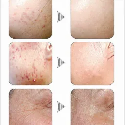 Porównanie stanu skóry twarzy przed i po zabiegu: redukcja trądziku, przebarwień i zmarszczek pokazana na zbliżeniach fragmentów skóry.