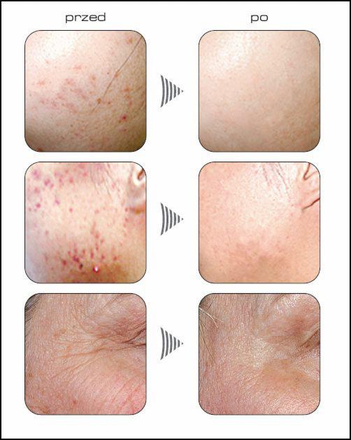 Porównanie stanu skóry twarzy przed i po zabiegu: redukcja trądziku, przebarwień i zmarszczek pokazana na zbliżeniach fragmentów skóry.
