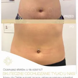 Zdjęcie 'przed i po' prezentujące efekt zabiegu odchudzającego na brzuchu kobiety z piercingiem w pępku, z zaznaczonymi obszarami przed zabiegiem i widoczną redukcją tkanki tłuszczowej po zabiegu.