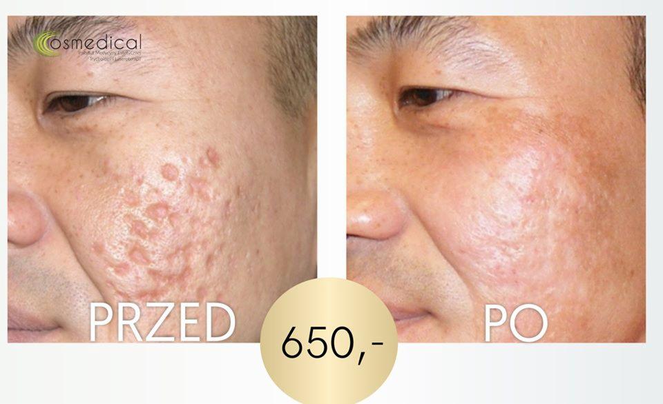 Porównanie efektów zabiegu: skóra twarzy mężczyzny przed i po redukcji blizn potrądzikowych, widoczne wyraźne zmniejszenie widoczności blizn, logo kliniki w lewym górnym rogu, cena zabiegu 650 zł.