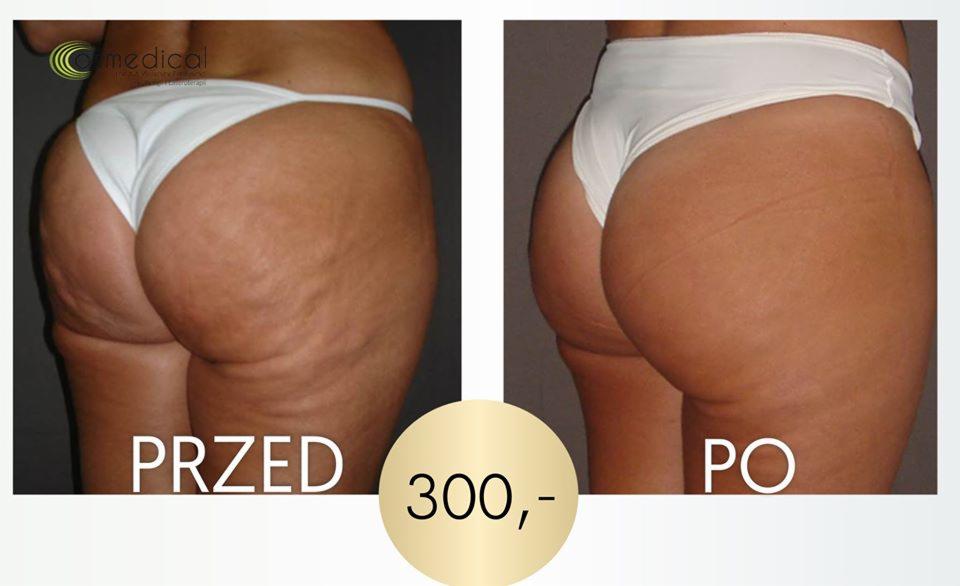 Zdjęcie porównawcze: po lewej skóra z cellulitem, po prawej gładka skóra po zabiegu, widoczna cena 300.