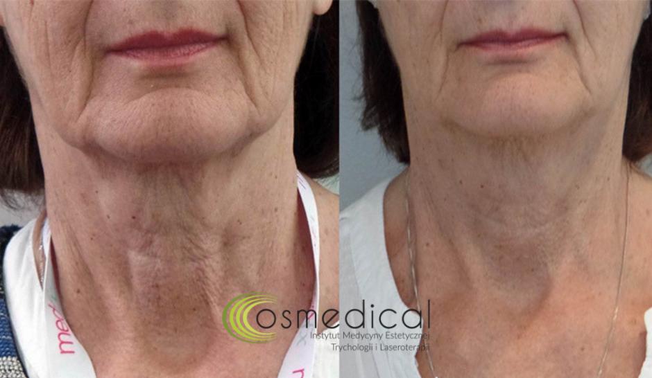 Zdjęcie 'przed i po' przedstawiające szyję i dekolt kobiety, ukazujące redukcję zmarszczek i poprawę napięcia skóry. Po lewej stronie widoczna szyja przed zabiegiem, po prawej - po zabiegu.