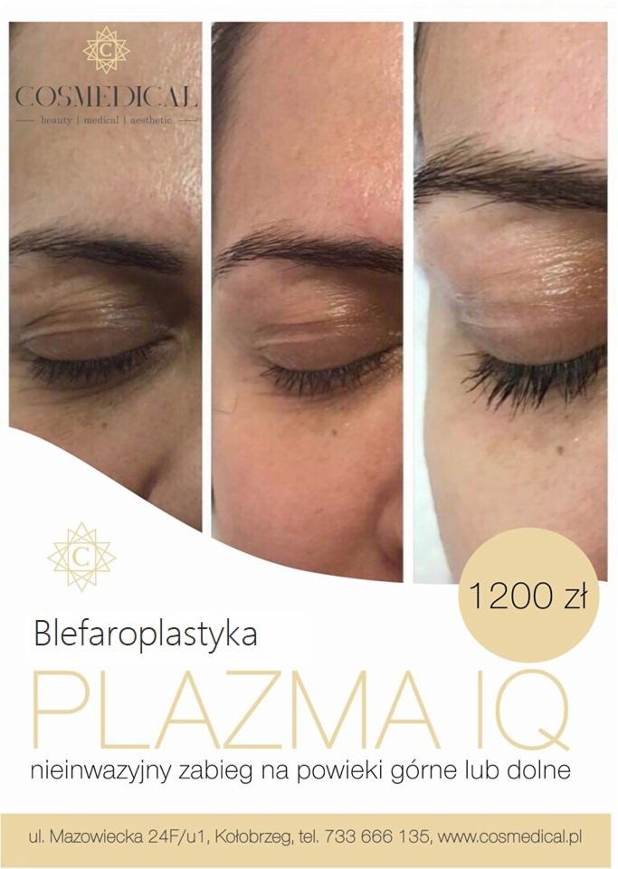Zdjęcie typu przed i po prezentujące efekt blefaroplastyki plazmą IQ na powiekach, z widoczną poprawą napięcia skóry; w tle logo firmy i informacja o cenie zabiegu.
