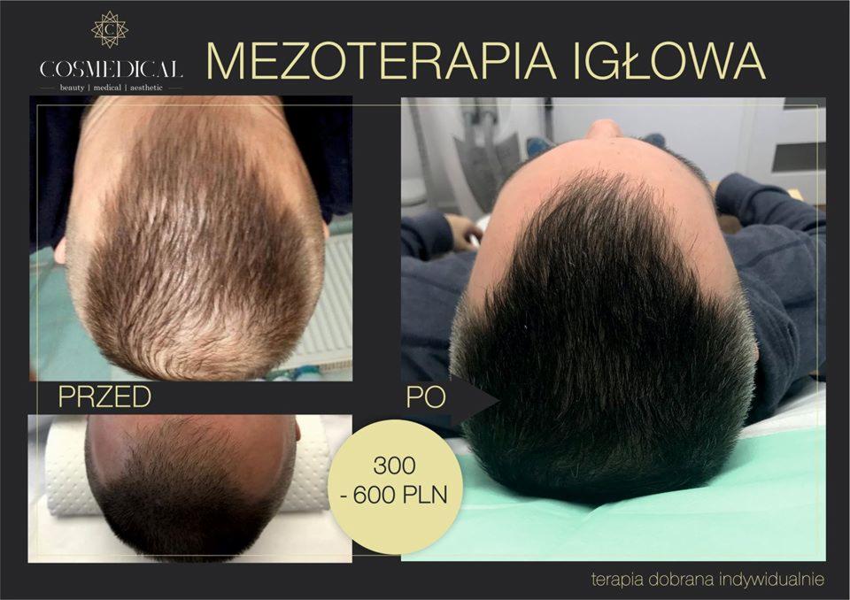 Zdjęcie prezentuje efekt przed i po zabiegu mezoterapii igłowej skóry głowy mężczyzny, wykonane z góry. Na zdjęciu po prawej stronie włosy są wyraźnie gęstsze i ciemniejsze.