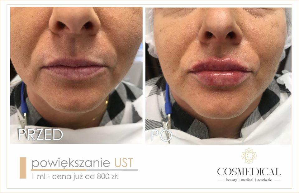 Zbliżenie na twarz kobiety przed i po zabiegu powiększania ust, widoczne zmiany w objętości i kształcie warg, z uwzględnieniem efektu błyszczących ust po zabiegu oraz logo firmy.