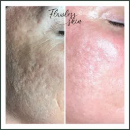 Por&oacute;wnanie sk&oacute;ry twarzy przed i po zabiegu, widoczne zmniejszenie blizn i poprawa tekstury.