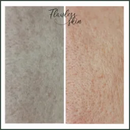 Por&oacute;wnanie sk&oacute;ry twarzy przed i po zabiegu, widoczne zmniejszenie por&oacute;w i poprawa tekstury; napis 'Flawless skin' w prawym g&oacute;rnym rogu.