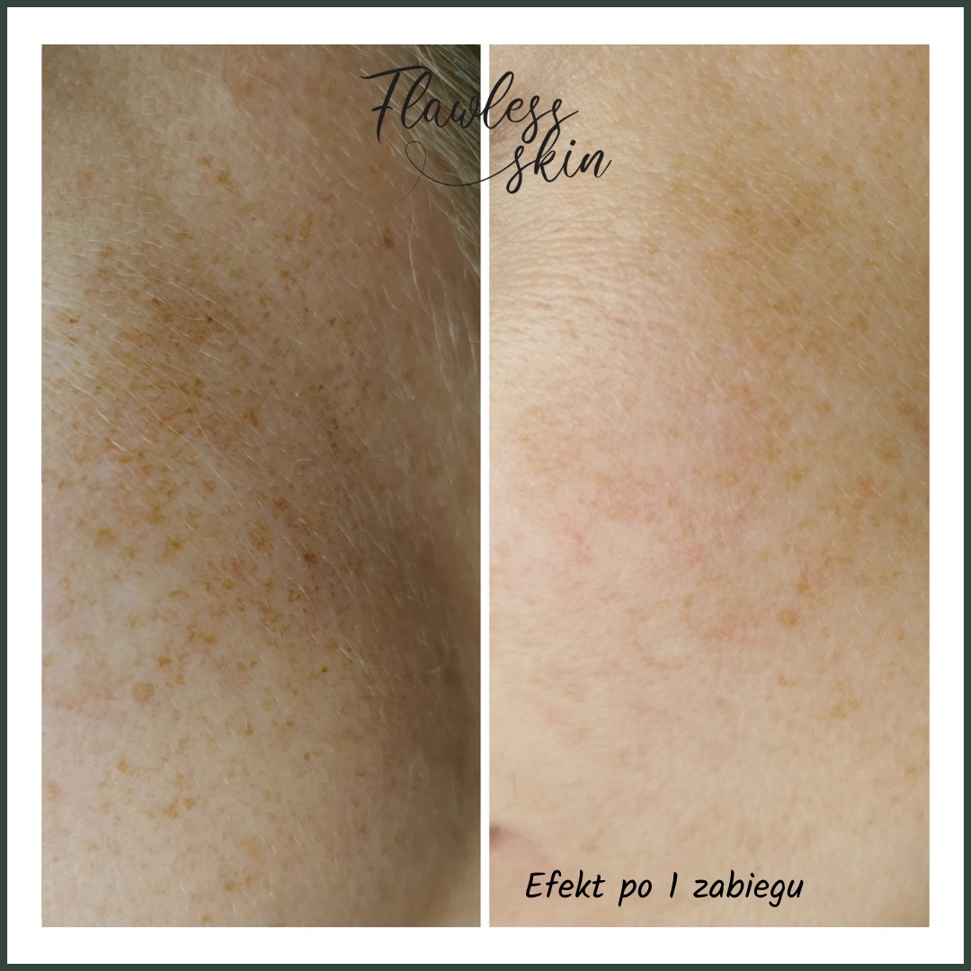 Porównanie skóry twarzy przed i po pierwszym zabiegu, redukcja przebarwień i poprawa kolorytu, widoczne naczynka.