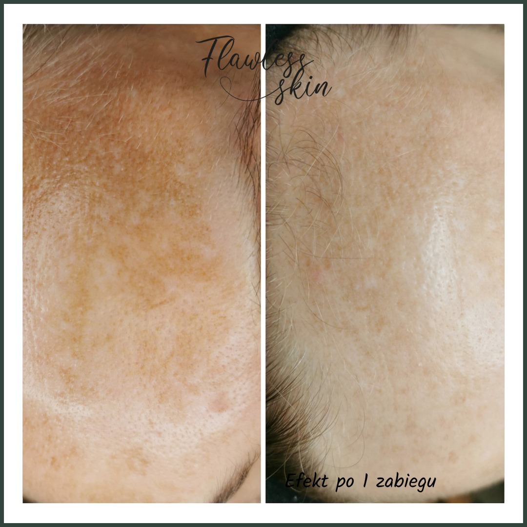 Porównanie skóry twarzy przed i po jednym zabiegu redukującym przebarwienia, widoczne zmniejszenie ilości i intensywności plam pigmentacyjnych na czole.