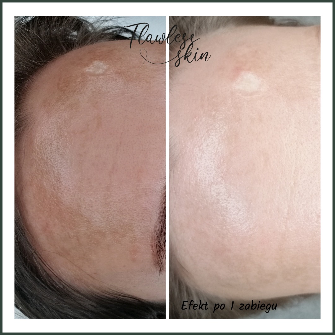 Porównanie skóry twarzy przed i po pierwszym zabiegu, widoczna poprawa kolorytu i redukcja przebarwień, z bliska ukazane czoło.
